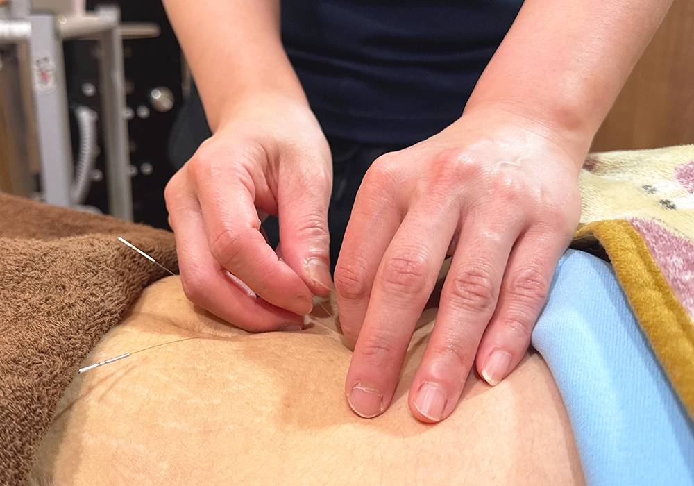 鍼灸施術のイメージ