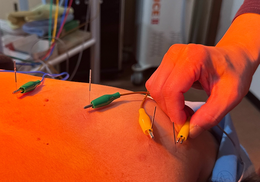 鍼灸施術のイメージ