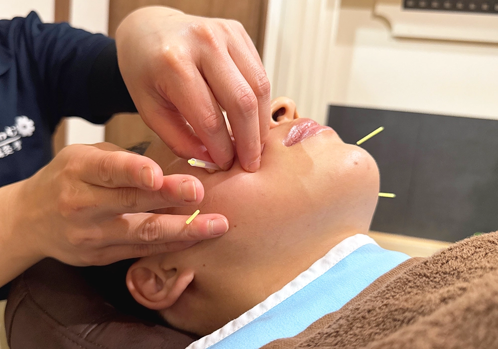 鍼灸施術のイメージ